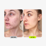 LED Esthetics Glotech™ Mask Pro + Collar