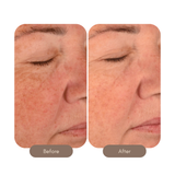 The Laser Serum Triple Acid Concentrate
