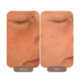 The Laser Serum Triple Acid Concentrate